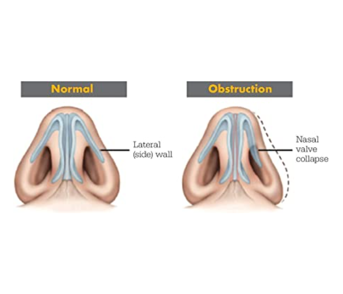 Galaxy 30 Pieces Breathing Nasal Strips - Zoom Image 4